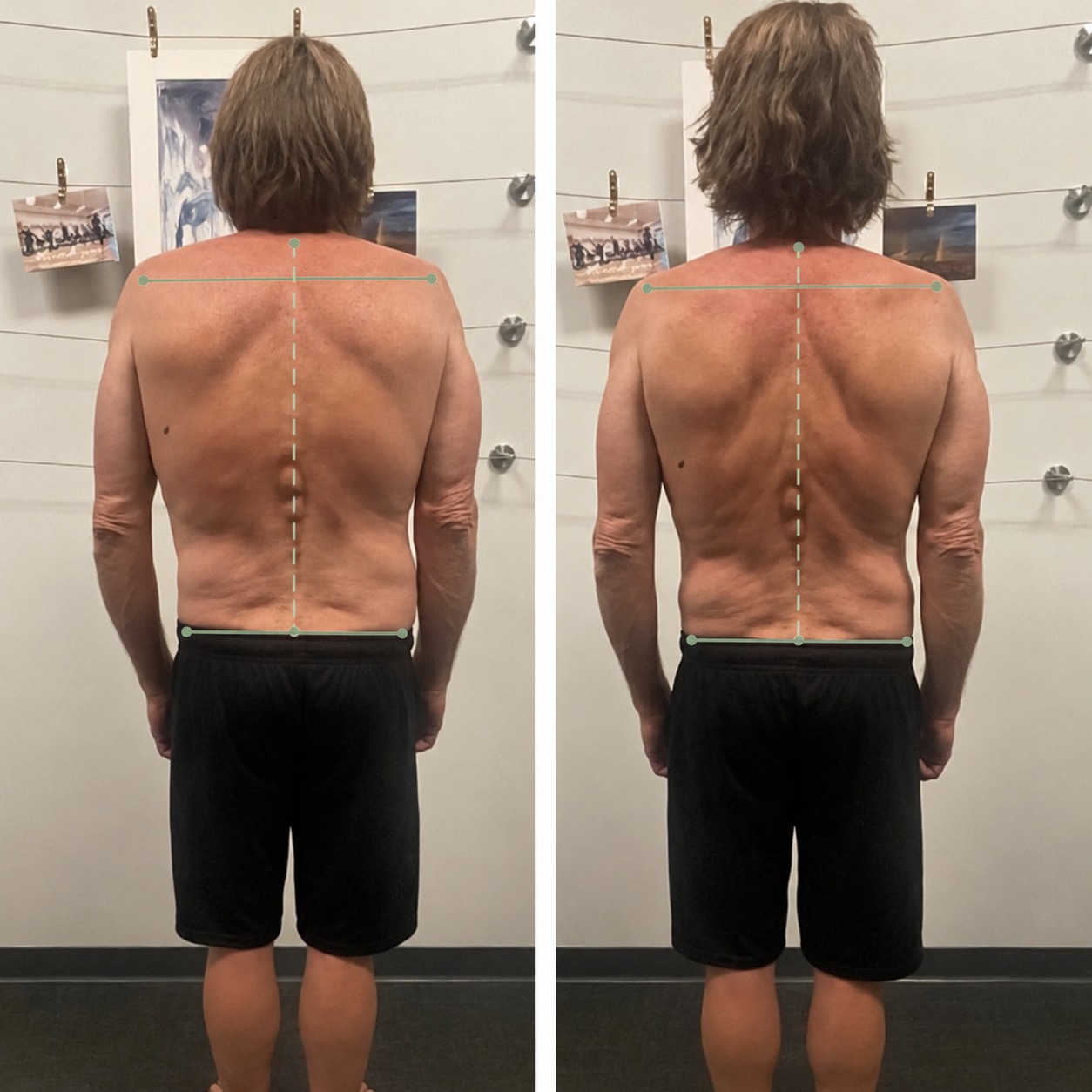 Scapular & Shoulder Symmetry — Before and After